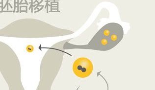 重度宫腔粘连在灵宝市做试管婴儿靠谱吗？重度宫腔粘连试管婴儿成功率多少